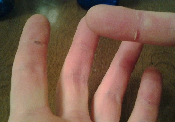 Two Blisters and a Split